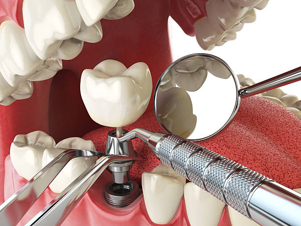Best Emergency Gum Treatment in Farmington, MO